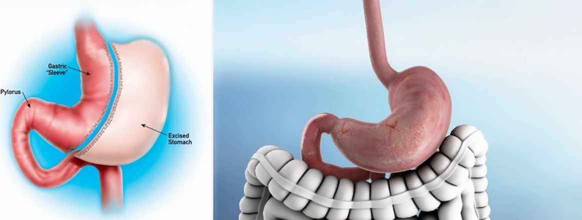 Gastric Balloon Weight Loss